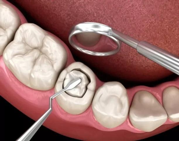 Dental Filling