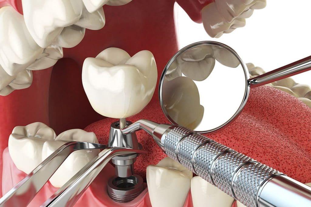 Dental Implants