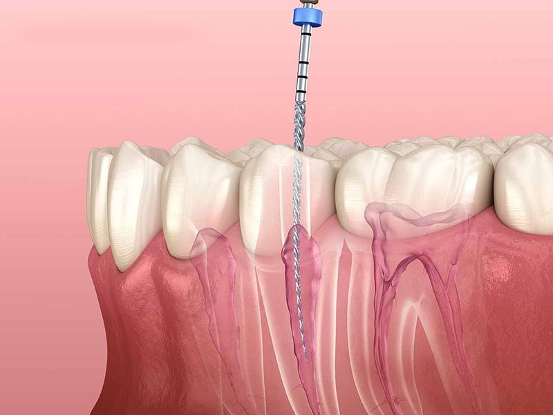 Root Canal Treatment