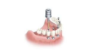 immediat implant