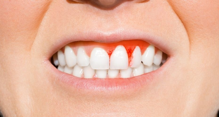 Dental Calculus
