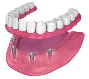 all-on-four implant