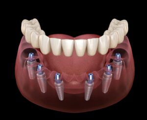 all-on-six implant
