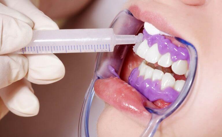 Teeth Whitening
