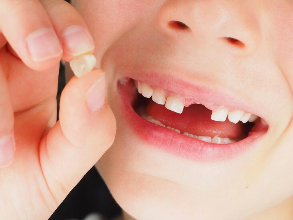 Tooth Extraction