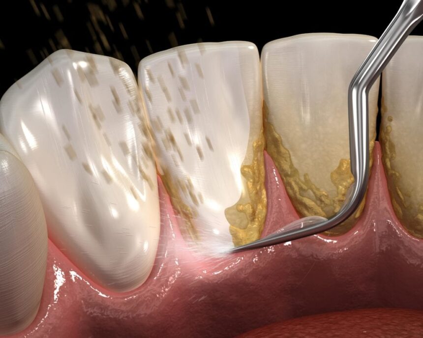 Teeth Cleaning and Scaling - Rainbow Dental Clinic