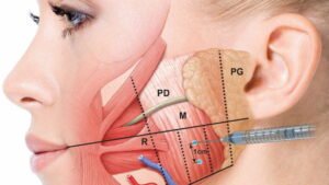 Masseter Botox