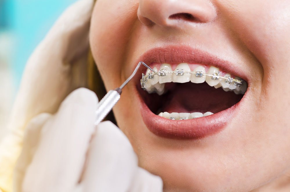 Orthodontic Treatment - Rainbow Dental Clinic