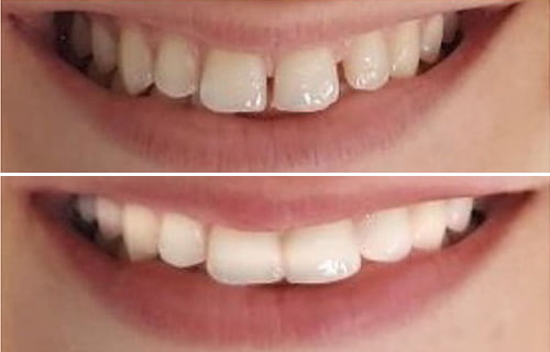 Smile Design