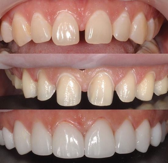Composite Bonding
