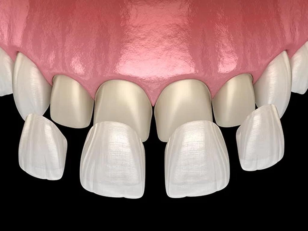 Smile Design