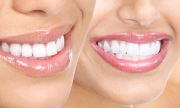 Unterschiede zwischen Zirkonkrone und Porzellankrone für Zahnverblendungen