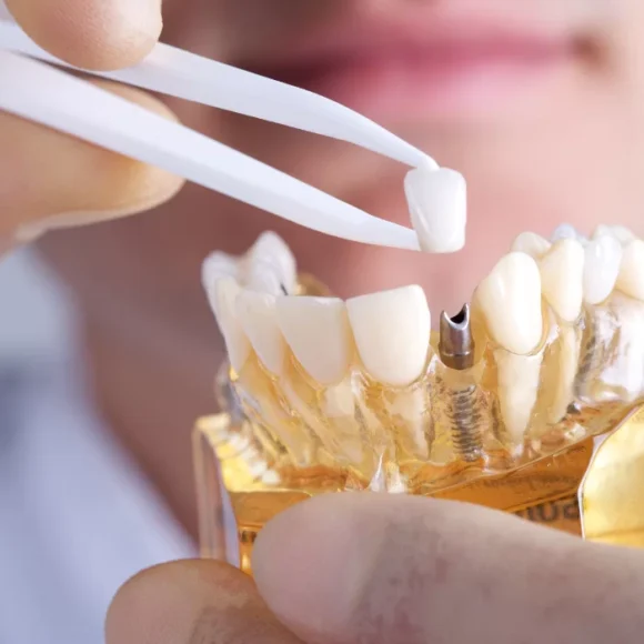 Implantat und Zirkonium-Zahnharmonie: Ästhetische und Funktionale Exzellenz